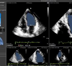 Epsilon Imaging Demonstrates Strain Imaging Integration for Echo Programs at ASE 2018