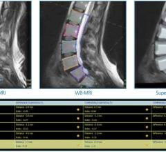 Esaote Launches Q-Spine Analysis Software