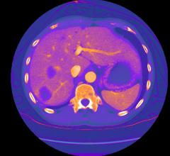 GE Healthcare, GSI Xtream, FDA clearance, spectral CT, Revolution, RSNA 2017