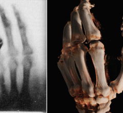 Left, the first X-ray ever made of Roentgen's wife's hand in 1895. Right, a cone-beam CT 3-D reconstruction of a hand in 2015 using a new robotic digital radiography (DR) X-ray system. 