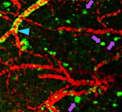 Alzheimer's disease, early diagnosis, PET scans, imaging compound, Fluselenamyl