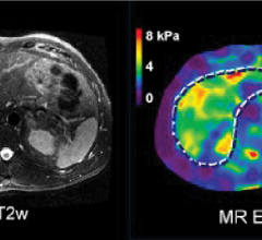 Resoundant Inc., announced hat it has entered into a strategic partnership with United Imaging Healthcare to begin offering advanced magnetic resonance elastography (MRE) on leading United Imaging MRI systems.