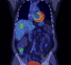 PET/CT helps bring personalized medicine within reach of practitioners. (Image courtesy of GE Healthcare)