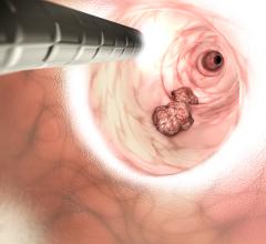 Recommendations address patient selection and treatment techniques for locally advanced disease