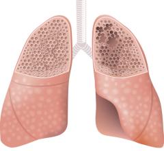 #emphysema #marijuana 2021 ARRS Virtual Annual Meeting research reveals increased rates of emphysema in marijuana smokers, compared to both non-smokers and tobacco-only smokers, as well as greater rates of paraseptal emphysema