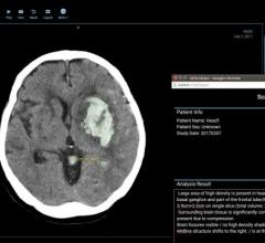 Medical Societies Issue Revised, Patient-Centered Measures for Stroke Interventions