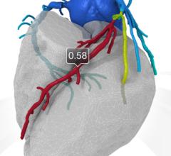 Philips to Develop FFR-CT in Partnership With HeartFlow