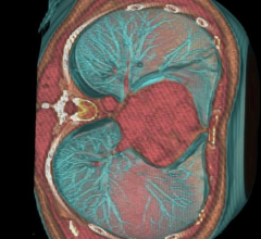 statins, heart scan, CT scan