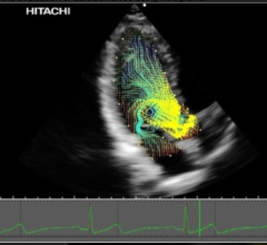 Hitachi, Vector Flow Mapping, TedMed 2016, Partho Sengupta, holographic evaluation of cardiac valves