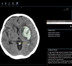 Infervision Releases InferTEST Program at SIIM 2019