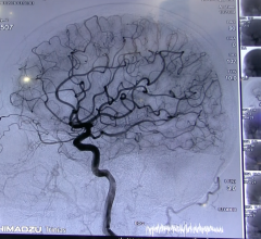 Marcus Stroke Network Established in Southeast U.S.