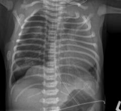 RSNA Announces Pneumonia Detection Machine Learning Challenge