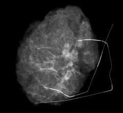 Kubtec Brings Image Analytics Capabilities to Tomosynthesis Specimen Imaging Systems