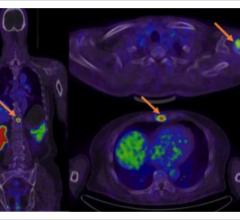 PET/CT Changes Care for 59 Percent of Suspected Recurrent Prostate Cancer Cases