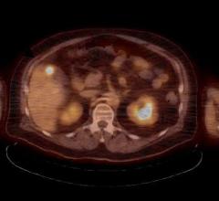 BTG, LC Bead LUMI, radiopaque embolic bead, Philips Healthcare, Live Image Guidance, liver cancer