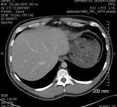 Median Technologies to Lead Roundtable on Applications of iBiopsy for Nonalcoholic Steatohepatitis