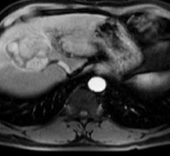 ACR LI-RADS Steering Committee Releases New Version of CT/MRI LI-RADS