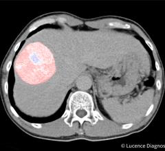 Lucence Diagnostics to Develop AI Tools for Liver Cancer Treatment