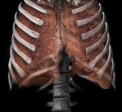  Lung 3D from CT scan_Vital Images