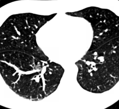 lung cancer screening, low dose computed tomography, LDCT, current and former smokers, JAMA Oncology study