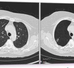 Researchers Use Radiomics to Overcome False Positives in Lung Cancer CT Screening