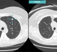 Matchedcrosshairs RSNA 2013 advanced visualization pacs accessories fusion