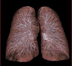 subsolid lung nodules, lung cancer, CT screening, women and men, NLST