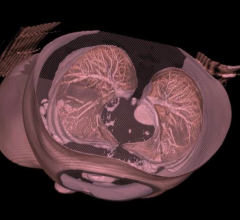 Mirada Medical and Optellum Debut AI-Based Lung Cancer Diagnosis Solution at RSNA 2017