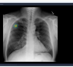 AI Biomarker Demonstrates High Predictive Power for Lung Cancer Immunotherapy