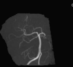 intracranial aneurysm, endovascular treatment, EVT, MRA, Naggara