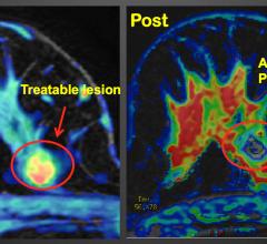 women's health rsna 2013 mri systems radiation therapy ultrasound