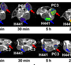 Novel MRI Imaging Agent More Effectively Monitors Impact of Treatment in Lung, Prostate Cancers