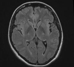 second language, brain connection strength, resting state functional magnetic resonance imaging, fMRI study, Journal of Neuroscience