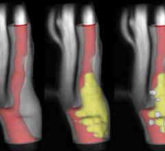 GE, VPDiagnostics Collaborate on MRI of Carotid Artery Atherosclerosis Imaging, Plaque Analysis