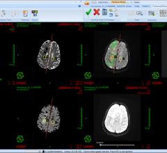 Impaired Brain Pathways May Cause Attention Problems After Stroke