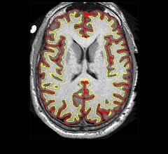 Study Finds Multiple Sclerosis Drug Slows Brain Shrinkage