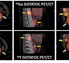 neuroendocrine tumors, NET, radiotherapy dose, PET, SPECT, SNMMI 2016