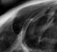 FDA Proposes New Rules for Mammography Reporting and Quality Improvement