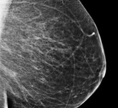 Bielefeld University Germany study, mammography screening, informed decisions