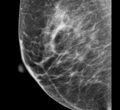 Mammography NHS Breast Screening Programme London United Kingdom