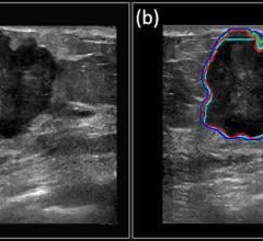 How AI and Deep Learning Will Enable Cancer Diagnosis Via Ultrasound