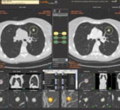 MEDIAN Assists in Managing Response to Lung, Liver Therapy  