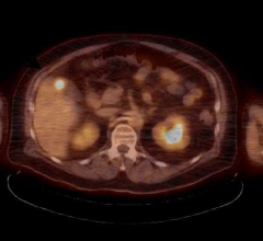 Proton Therapy Radiation X-Ray Liver Metastases