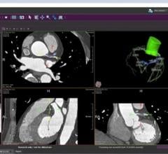 Medis Releases QAngio CT v3.1