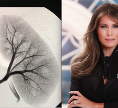 Melania Trump in hospital to undergo an interventional radiology (IR) catheter embolization procedure in her kidneys. Angiogram of a kidney.