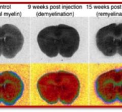 PET Tracer Measures Damage From Multiple Sclerosis in Mouse Models