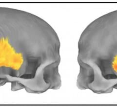 "Residual Echo" of Ancient Humans May Hold Clues to Mental Disorders