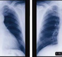 Study Shows Improved Detection of Lung Cancer With CAD Technology