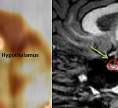 Nuclear imaging, PET/CT, Clinical Trial/Study, RSNA 2014