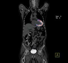 ASNC and SNMMI Release Joint Document on Diagnosis, Treatment of Cardiac Sarcoidosis